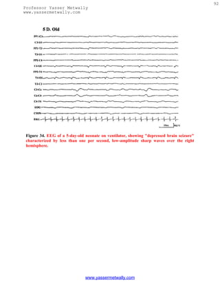 92
Professor Yasser Metwally
www.yassermetwally.com




 Figure 34. EEG of a 5-day-old neonate on ventilator, showing "depressed brain seizure"
 characterized by less than one per second, low-amplitude sharp waves over the right
 hemisphere.




                               www.yassermetwally.com
 