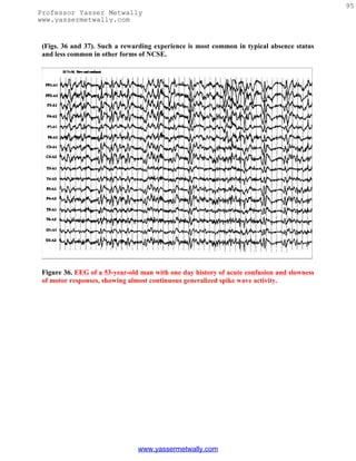 95
Professor Yasser Metwally
www.yassermetwally.com


 (Figs. 36 and 37). Such a rewarding experience is most common in typical absence status
 and less common in other forms of NCSE.




 Figure 36. EEG of a 53-year-old man with one day history of acute confusion and slowness
 of motor responses, showing almost continuous generalized spike wave activity.




                                www.yassermetwally.com
 