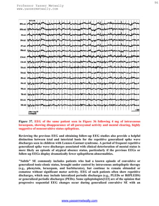 96
Professor Yasser Metwally
www.yassermetwally.com




 Figure 37. EEG of the same patient seen in Figure 36 following 4 mg of intravenous
 lorazepam, showing disappearance of all paroxysmal activity and mental clearing, highly
 suggestive of nonconvulsive status epilepticus.

 Reviewing the previous EEG and obtaining follow-up EEG studies also provide a helpful
 distinction between ictal and interictal basis for the repetitive generalized spike wave
 discharges seen in children with Lennox-Gastaut syndrome. A period of frequent repetitive
 generalized spike wave discharges associated with clinical deterioration of mental status is
 more likely an episode of atypical absence status, particularly if the previous EEGs or
 follow-up EEGs display dramatically fewer epileptiform abnormalities.

 "Subtle" SE commonly includes patients who had a known episode of convulsive or
 generalized tonic-clonic status, brought under control by intravenous antiepileptic therapy
 (e.g., phenytoin, lorazepam, and barbiturates), but continue to remain obtunded or
 comatose without significant motor activity. EEG of such patients often show repetitive
 discharges, which may include lateralized periodic discharges (e.g., PLEDs or BiIPLEDS)
 or generalized periodic discharges (PEDs). Some epileptologists[123] are of the opinion that
 progressive sequential EEG changes occur during generalized convulsive SE with an




                                 www.yassermetwally.com
 