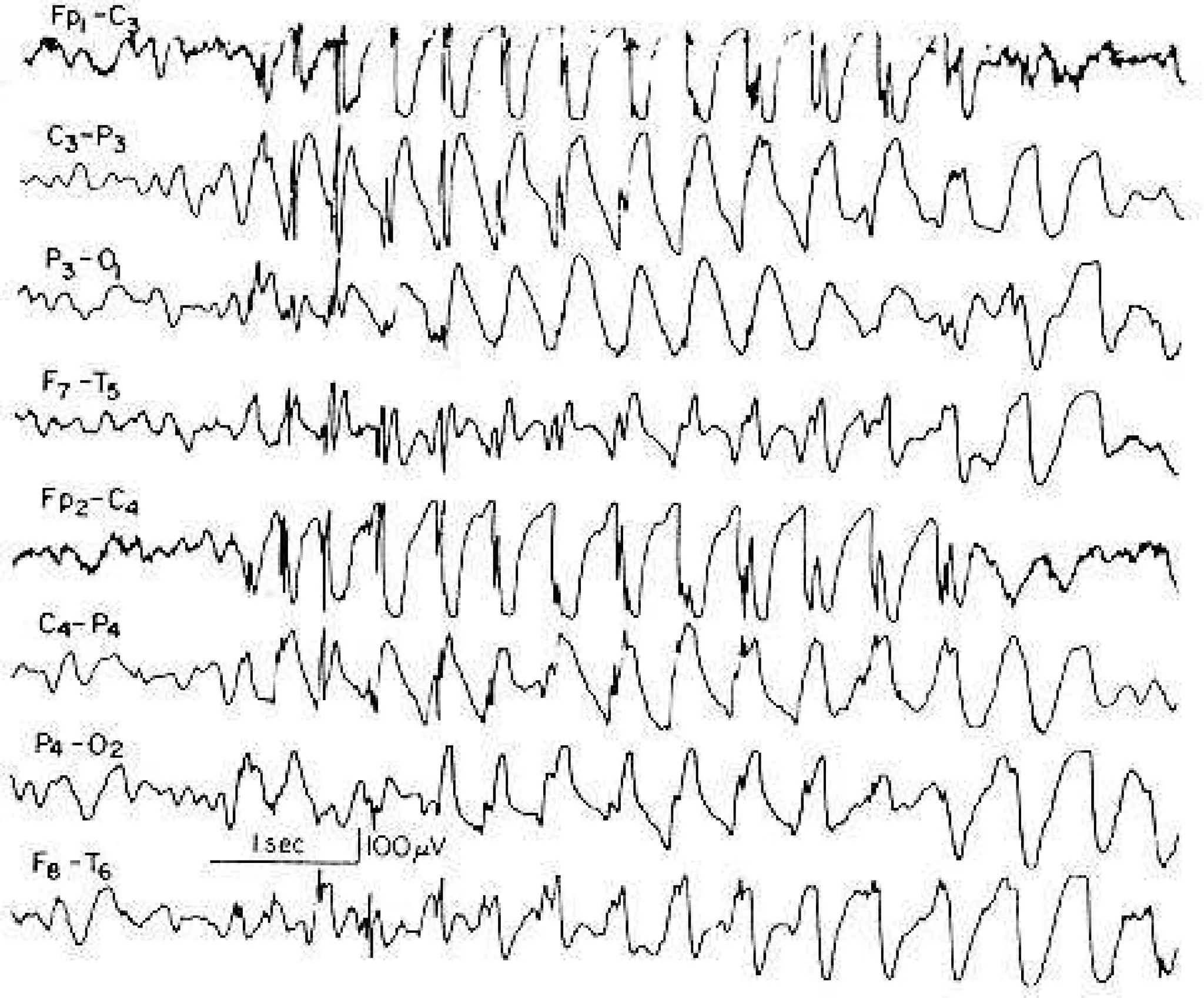 Definition of Some conventional EEG terminologies | PPT