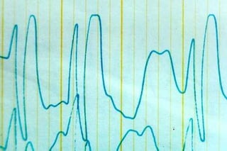 Definition of Some conventional EEG terminologies | PPT