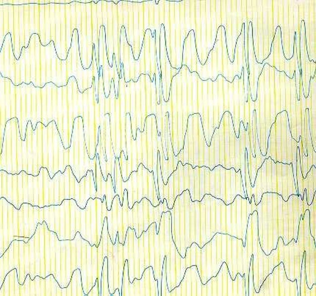 Definition of some conventional eeg terminologies ppt