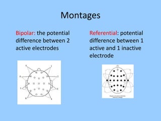 Montages 
Bipolar: the potential 
difference between 2 
active electrodes 
Referential: potential 
difference between 1 
active and 1 inactive 
electrode 
 