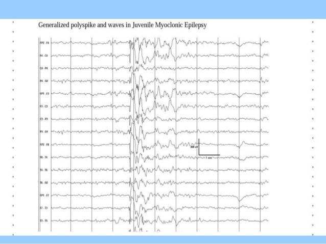 what does eeg show
