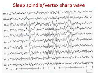 Vertex Wave EEG in neurology and psychiatry | PPTX