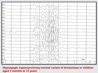 Hypnagogic hypersynchrony:normal variant of drowsiness in children
aged 3 months to 13 years.
 