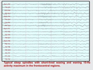 Typical sleep spindles with short-lived waxing and waning 15-Hz
activity maximum in the frontocentral regions.
 