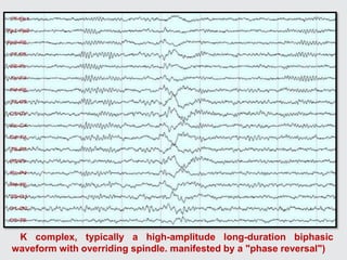 K complex, typically a high-amplitude long-duration biphasic
waveform with overriding spindle. manifested by a "phase reversal")
 
