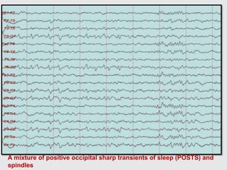 A mixture of positive occipital sharp transients of sleep (POSTS) and
spindles
 