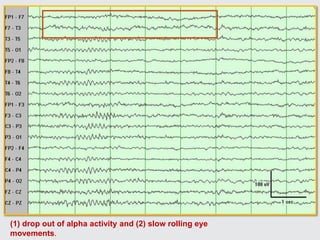 (1) drop out of alpha activity and (2) slow rolling eye
movements.
 