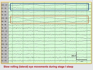 Slow rolling (lateral) eye movements during stage I sleep
 