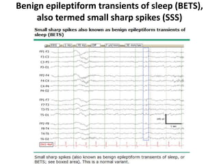 Benign epileptiform transients of sleep (BETS),
also termed small sharp spikes (SSS)
 