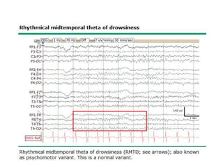 Eeg basics, part 1