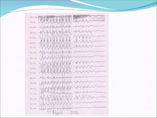 BASICS OF ELECTRO ENCEPHALOGRAM EEG - BASICS | PPTX