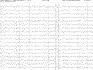 BASICS OF ELECTRO ENCEPHALOGRAM EEG - BASICS | PPTX