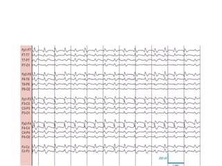 BASICS OF ELECTRO ENCEPHALOGRAM EEG - BASICS | PPTX