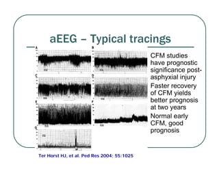 aEEG – Typical tracings
z CFM studies
have prognostic
significance post-
asphyxial injury
z Faster recovery
of CFM yields
better prognosis
at two years
z Normal early
CFM, good
prognosis
Ter Horst HJ, et al. Ped Res 2004; 55:1025
 