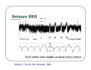 Seizure EEG
DeVries
DeVries L,
L, Toet
Toet M, Clin. Perinatol., 2006
M, Clin. Perinatol., 2006
Term infant with middle cerebral artery infarct
Term infant with middle cerebral artery infarct
 