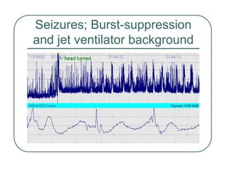Seizures; Burst-suppression
and jet ventilator background
 