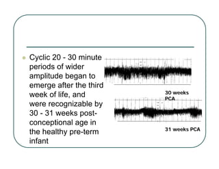 z Cyclic 20 - 30 minute
periods of wider
amplitude began to
emerge after the third
week of life, and
were recognizable by
30 - 31 weeks post-
conceptional age in
the healthy pre-term
infant
31 weeks PCA
31 weeks PCA
30 weeks
30 weeks
PCA
PCA
 