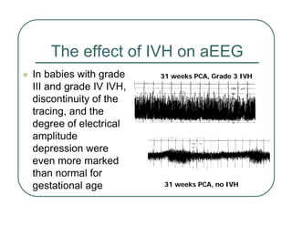 The effect of IVH on aEEG
z In babies with grade
III and grade IV IVH,
discontinuity of the
tracing, and the
degree of electrical
amplitude
depression were
even more marked
than normal for
gestational age
31 weeks PCA, Grade 3 IVH
31 weeks PCA, Grade 3 IVH
31 weeks PCA, no IVH
31 weeks PCA, no IVH
 