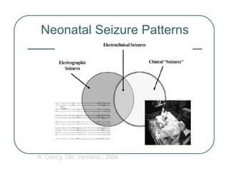 Neonatal Seizure Patterns
R. Clancy, Clin. Perinatol., 2006
R. Clancy, Clin. Perinatol., 2006
 