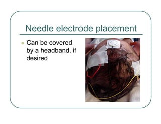 Needle electrode placement
z Can be covered
by a headband, if
desired
 
