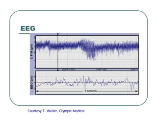 EEG
Courtesy T.
Courtesy T. Weiler
Weiler, Olympic Medical
, Olympic Medical
 