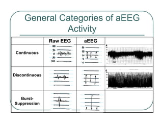 General Categories of aEEG
Activity
Burst-
Suppression
Discontinuous
Continuous
aEEG
Raw EEG
 