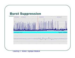 Burst Suppression
Courtesy T.
Courtesy T. Weiler
Weiler, Olympic Medical
, Olympic Medical
 
