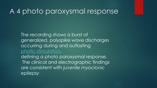 A 4 photo paroxysmal response
The recording shows a burst of
generalized, polyspike wave discharges
occurring during and outlasting
photic stimulation,
defining a photo paroxysmal response.
The clinical and electrographic findings
are consistent with juvenile myoclonic
epilepsy
 
