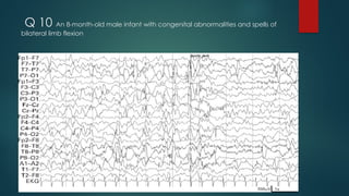 Q 10 An 8-month-old male infant with congenital abnormalities and spells of
bilateral limb flexion
.
 