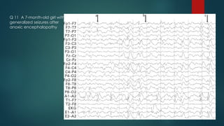 Q 11 A 7-month-old girl with
generalized seizures after
anoxic encephalopathy
(.
 