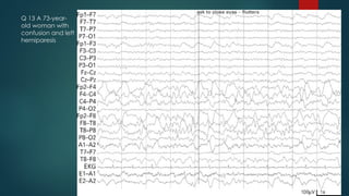 Q 13 A 73-year-
old woman with
confusion and left
hemiparesis
 