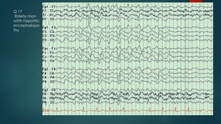 Q 17
Elderly man
witth hepattic
encephalopa
thy
 