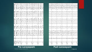 Pre-Lorazepam Post-Lorazepam
American Epilepsy Society 2015 E Slide 140
 