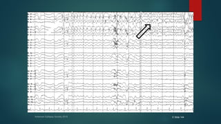 American Epilepsy Society 2015 E Slide 144
 