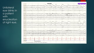 Unilateral
eye blinks in
a patient
with
enucleation
of right eye.
 