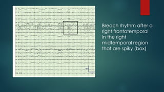 Breach rhythm after a
right frontotemporal
in the right
midtemporal region
that are spiky (box)
 