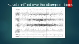 Muscle artifact over the bitemporal leads
 