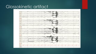 Glossokinetic artifact
 