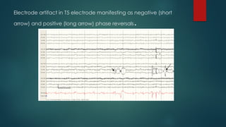 Electrode artifact in T5 electrode manifesting as negative (short
arrow) and positive (long arrow) phase reversals.
 