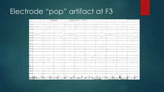 Electrode “pop” artifact at F3
 