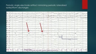 Periodic single electrode artifact mimicking periodic lateralized
epileptiform discharges
 