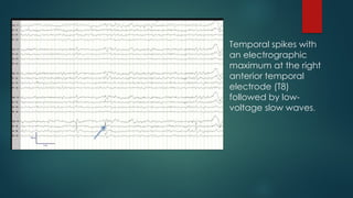 Temporal spikes with
an electrographic
maximum at the right
anterior temporal
electrode (T8)
followed by low-
voltage slow waves.
 