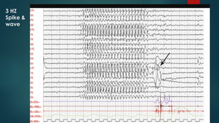 3 HZ
Spike &
wave
 