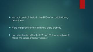  Normal burst of theta in the EEG of an adult during
drowsiness
 Note the prominent intermixed beta activity
 and electrode artifact at F7 and F3 that combine to
make the appearance “spikier.”
 