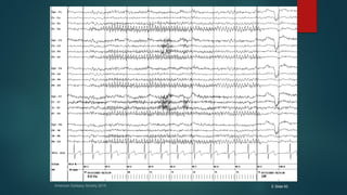 American Epilepsy Society 2015 E Slide 93
 