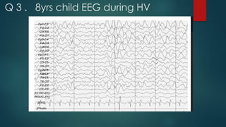 Q 3 . 8yrs child EEG during HV
 