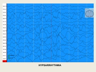 Cases of cns with EEG INTERPRETATION in paeds | PPTX